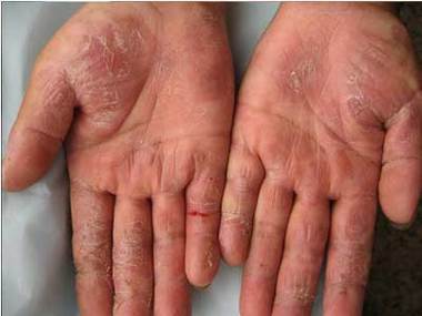 手部湿疹治疗指南：明确病因，科学护理，正确用药是关键