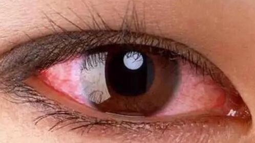 为什么眼球有血丝？揭秘红血丝成因与消除方法