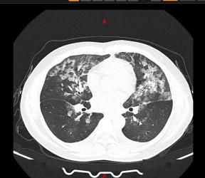 体检时尽量别做肺部CT：辐射与健康需权衡